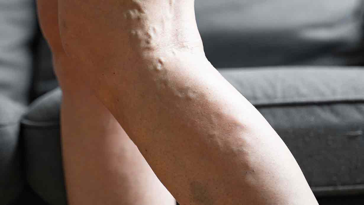 Causes of Varicose Veins