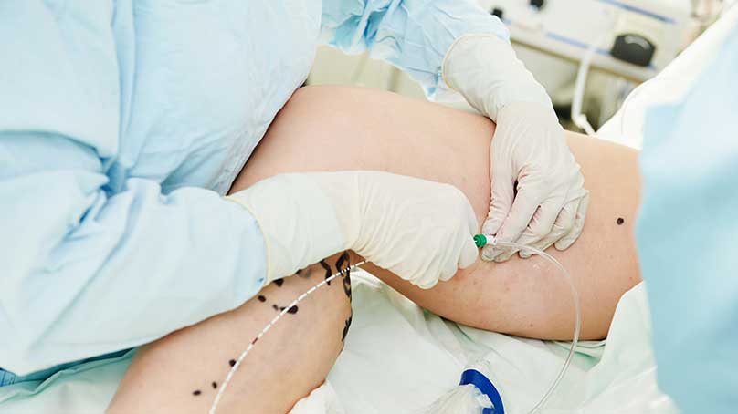 Performing Laser Coagulation