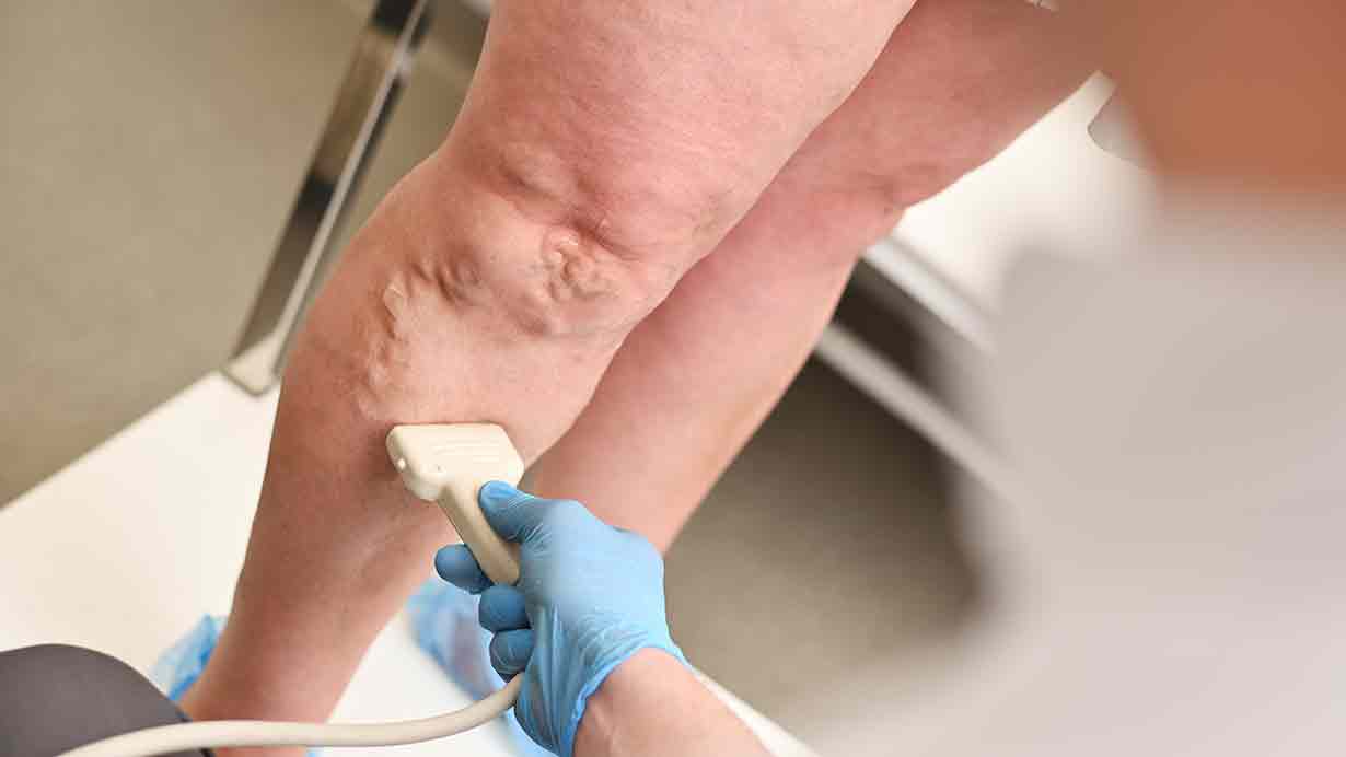 Endovenous Laser Coagulation (EVLC)