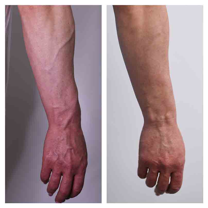 Laser treatment of upper limb veins in Kyiv before and after photos
