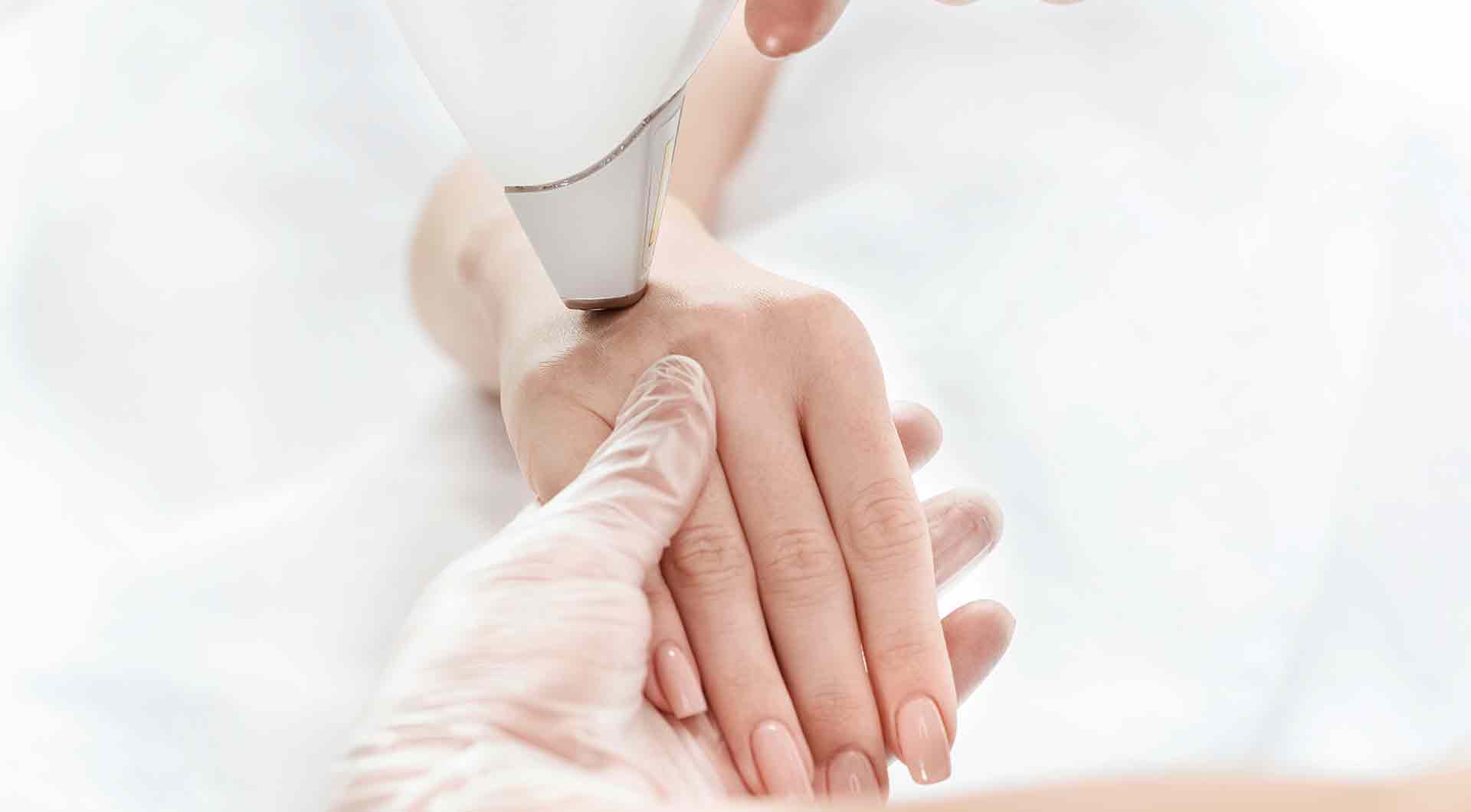 Laser treatment of upper limb veins