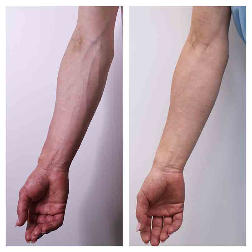 Vein treatment of upper limbs before and after photos